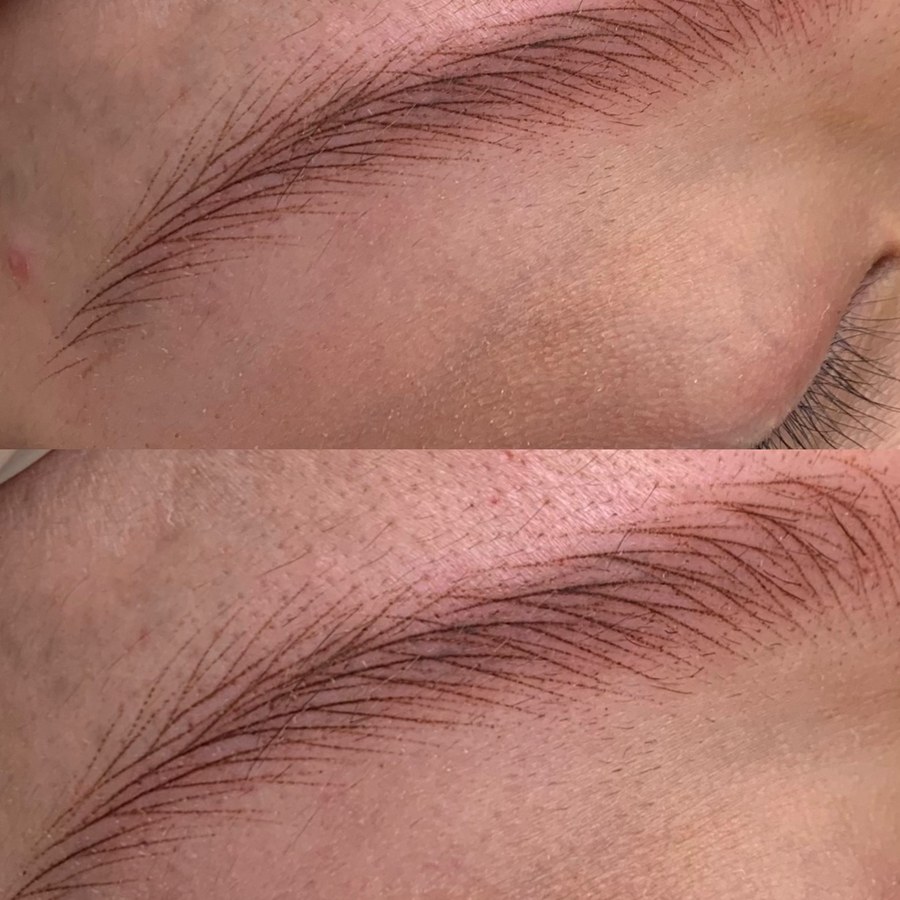 Resultado de micropigmentación de Phuon Phan